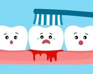 Gengiva inflamada entre os dentes: causas, sintomas e como tratar