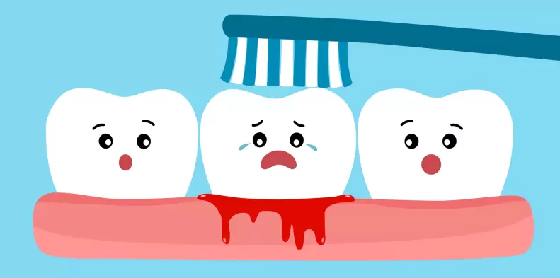 Gengiva inflamada entre os dentes: causas, sintomas e como tratar