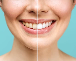 Tudo sobre clareamento dental: Dicas, tipos de tratamento e cuidados