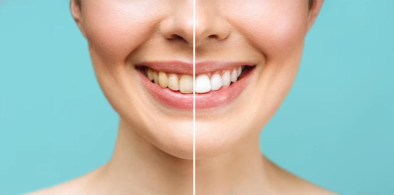 Tudo sobre clareamento dental: Dicas, tipos de tratamento e cuidados